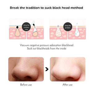 Red Korbin Pack blackhead remover